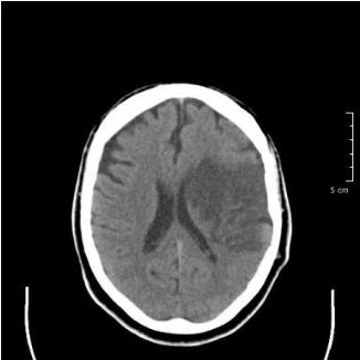 CT brain scan result